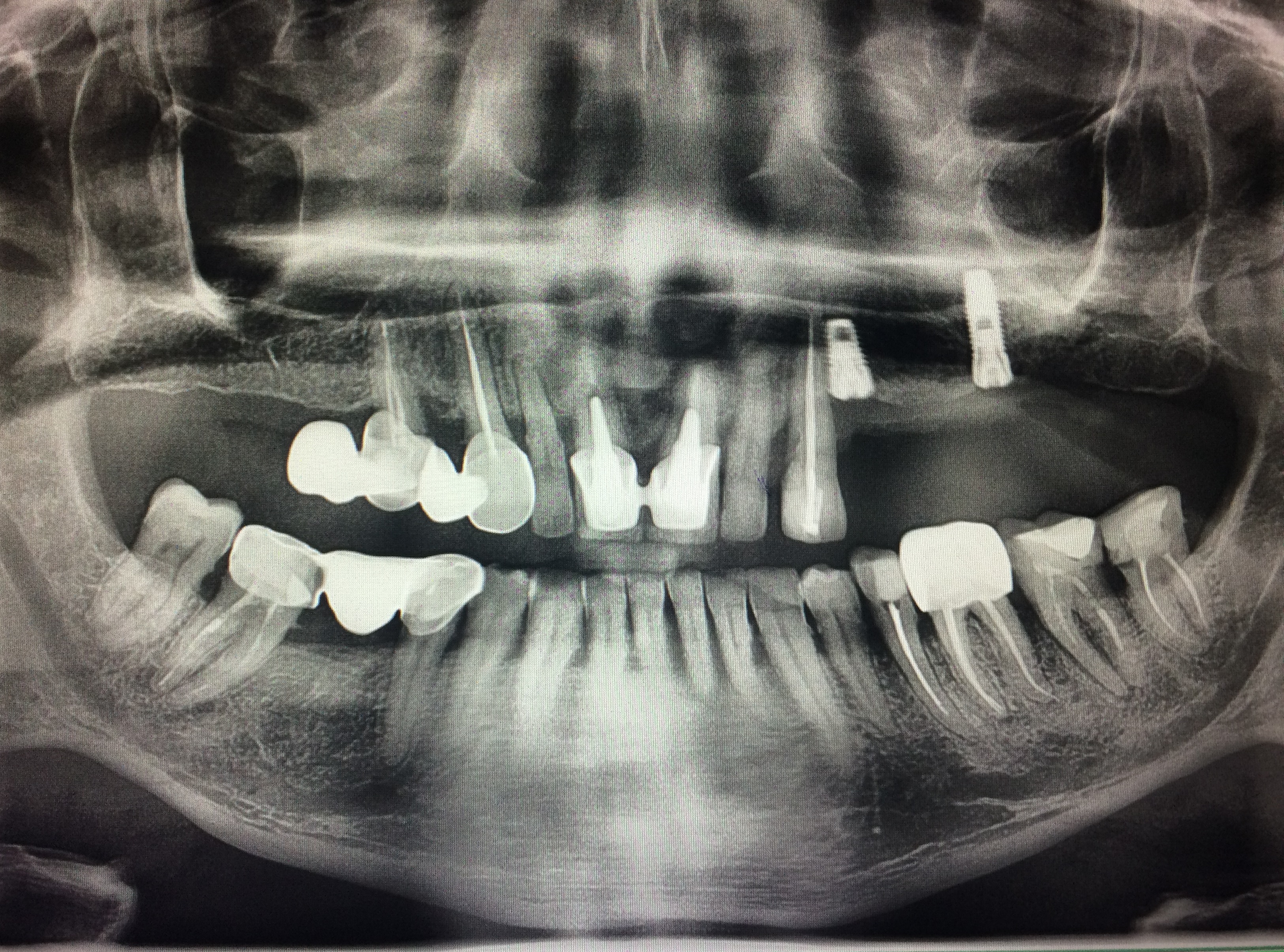Снимок. Рентген ортопантомограмма зубов. ОПТГ зубных рядов Пикассо. ОПТГ ортопантомограмма норма. Ортопантомограмма челюсти.