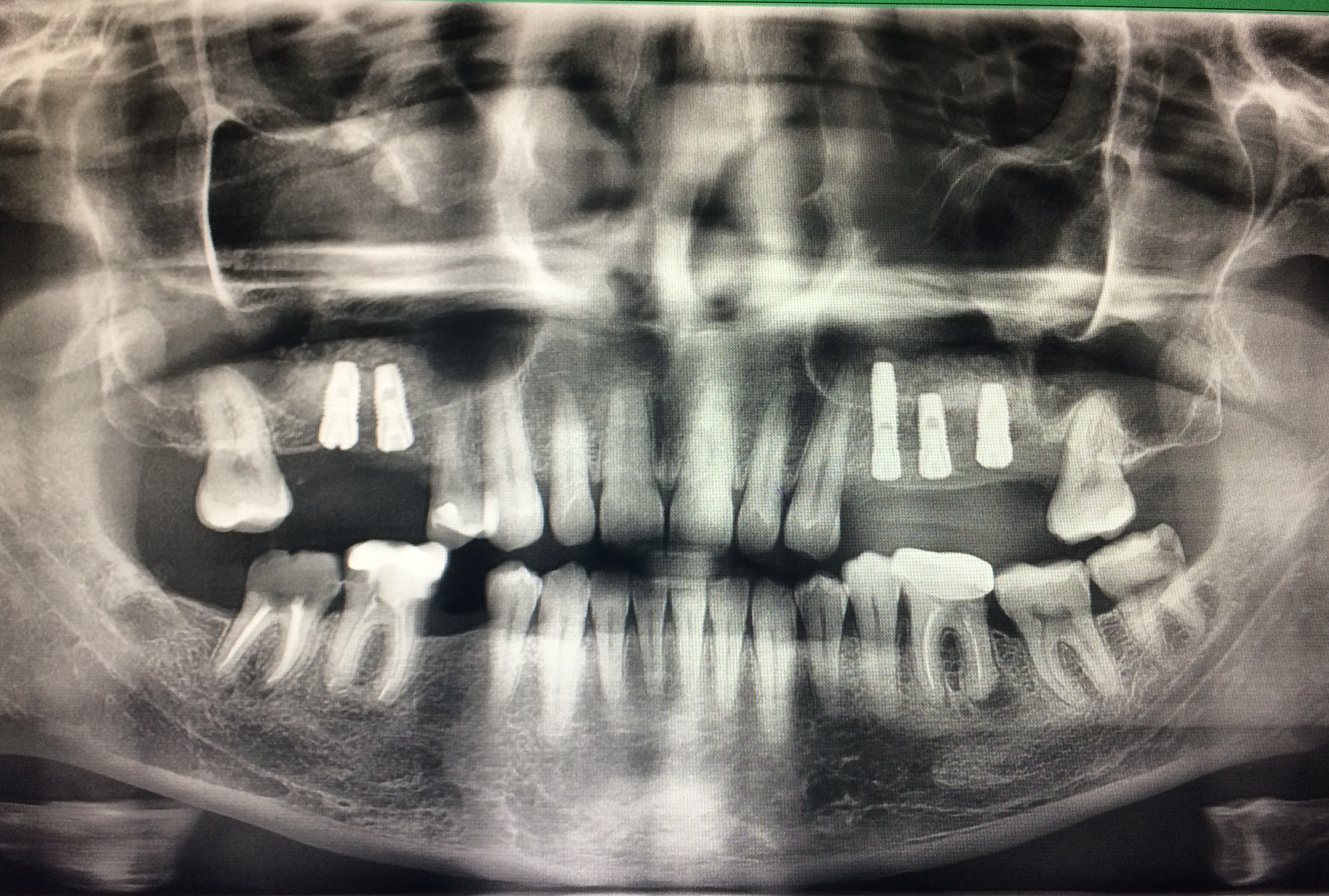 Снимок. Ортопантомограмма пульпит.